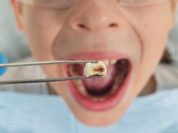 Best Emergency Dental Extractions in Mead Valley, CA